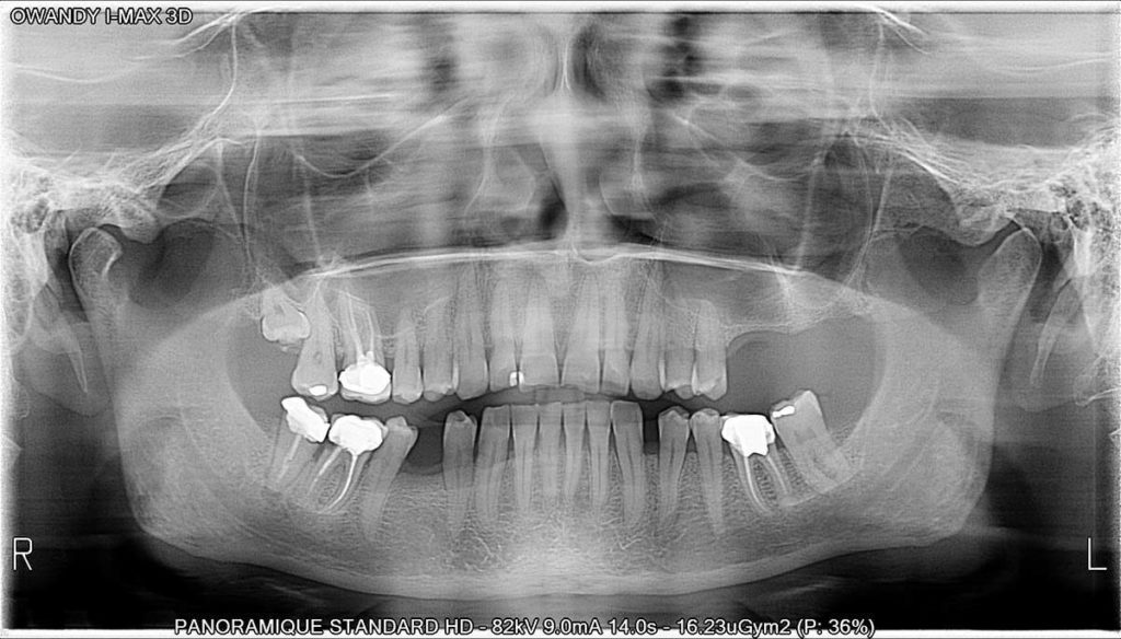 Panoramica dentale I-Max - Owandy Radiology Italia